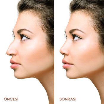 Burun Estetiği Nasıl Yapılır? Amacı Nedir?