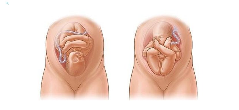 Bebek Ters Durduğunda Doğum Nasıl Olmalıdır?