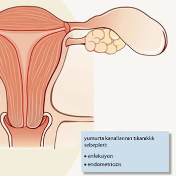 Tüp Tıkanıklığı ve Tüp Bebek Tedavisi